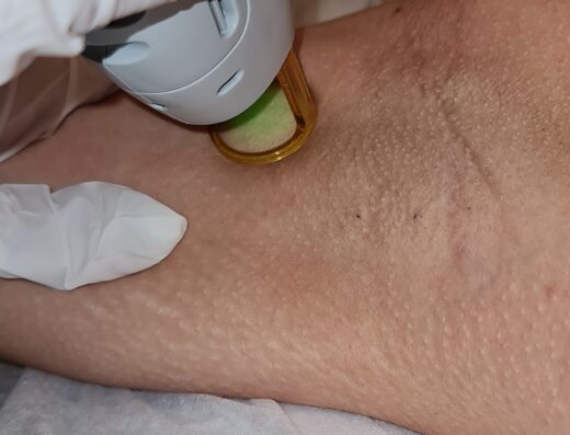 עינת לייזר קנדלה – Einat Candela Laser